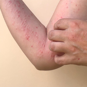 Inflammatory Conditions